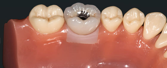 ซื้อ สวยงามสูง โลหะมีค่า Crown Implant โลหะมะพร้าว Crown สะพาน online manufacture