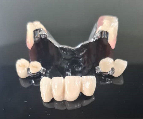 โครงสร้างโลหะ ความแม่นยํา การติดต่อ Overdenture ปักฟันปักฟัน