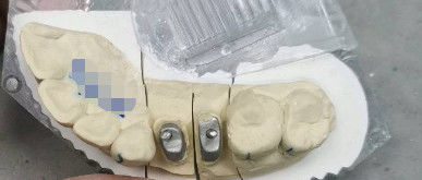 โลหะ / สาธารณะ Ti Base Crown Post Core Titanium Crowns สําหรับฟัน